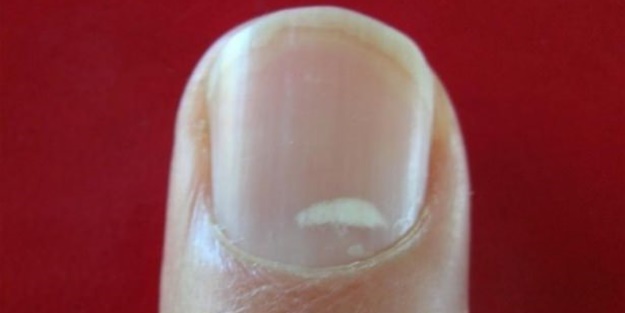 İşte tırnaklardaki beyaz lekelerin sebebi!
