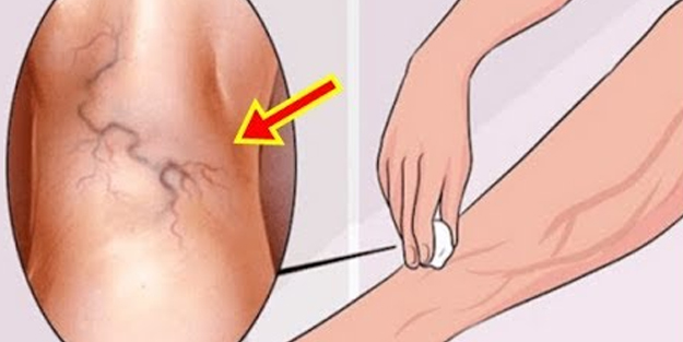 İşte varise savaş açan doğal yöntem: Evde sarımsak ile varis tedavisi