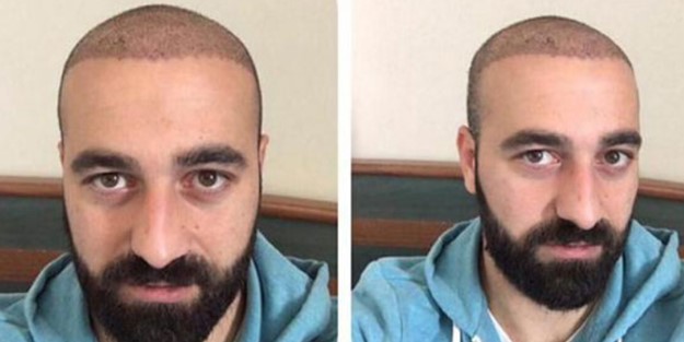 İzinsiz saç ektirdi, sözleşmesi feshedildi