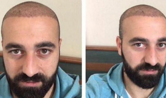 İzinsiz saç ektirdi, takımdan kovuldu!