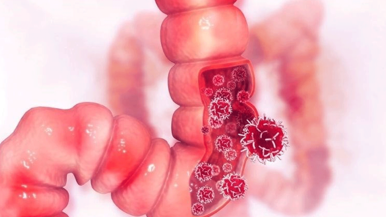 Japon bilim insanlarından mucize keşif! Bağırsak kanserini önlemenin yolu bulundu!