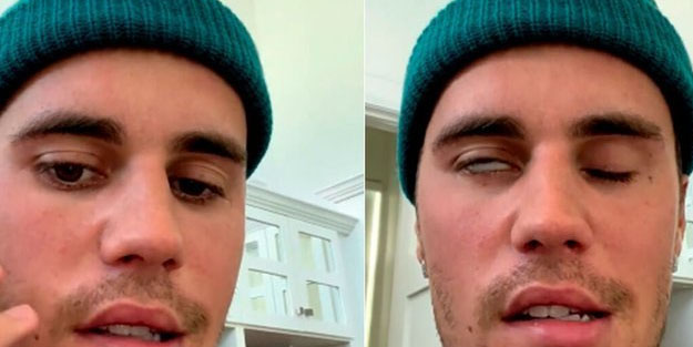 Justin Bieber: Ramsay Hunt sendromu nedir? Ramsay Hunt sendromu belirtileri neler?