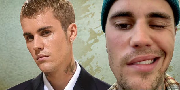 Justin Bieber'ın hastalığı Ramsay Hunt hastalığına yakalandı: Hunt sendromu belirtileri neler?