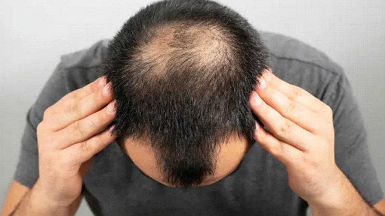 Kabuklarını atmayın: Kelliğin çaresi onda!