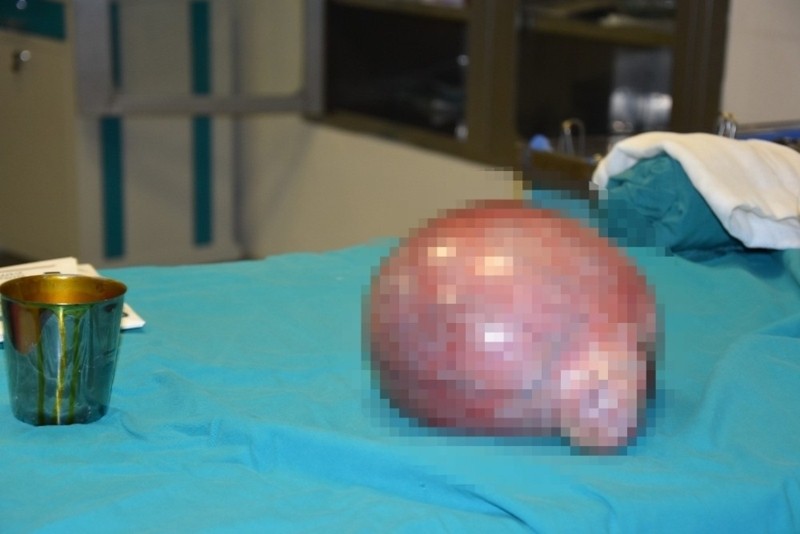 Böylesi daha önce görülmedi! Alınan tömür futbol topu büyüklüğünde