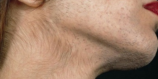 Kadınlarda aşırı tüylenme neden olur?