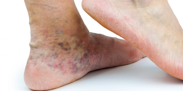 Kadınlarda en çok bu hastalık görülüyor