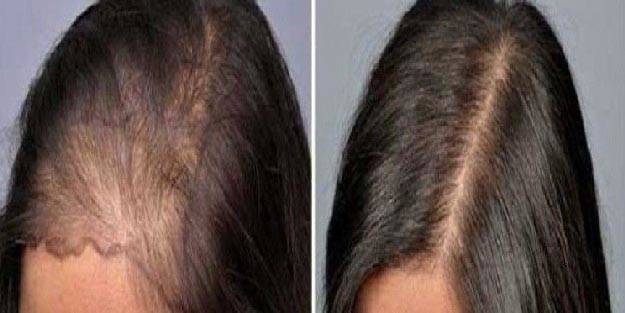 Kadınlarda kellik oranı yükseliyor