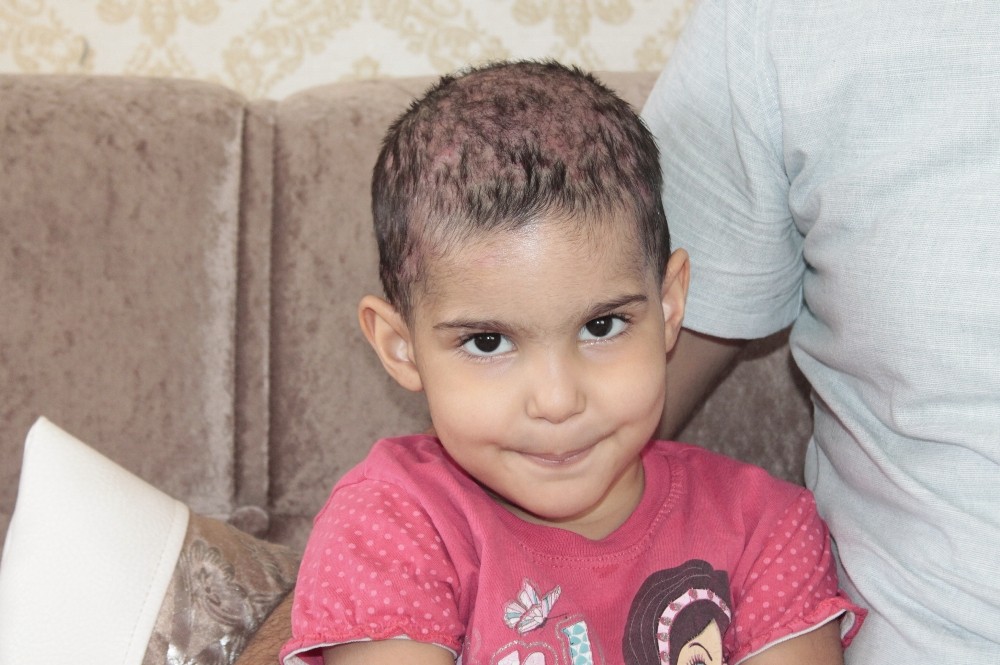 Kafa derisinde yaralar çıkan 3 yaşındaki Lorin’in tedavisine başlandı 
