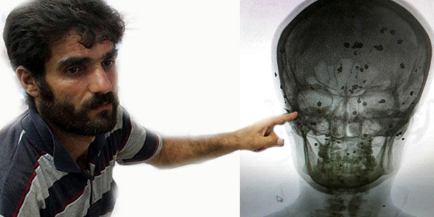 Kafasının içinde tam 80 tane saçma var!