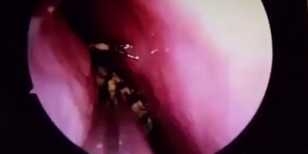 Kafatasından hamam böceği çıkarıldı!