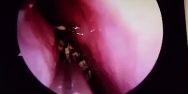 Kafatasından hamam böceği çıktı!