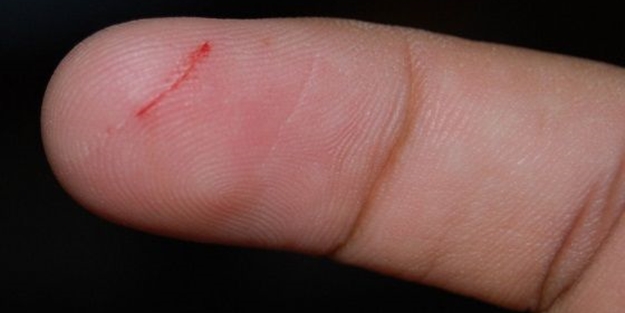 Kağıt kesiğinin neden çok acıtır?