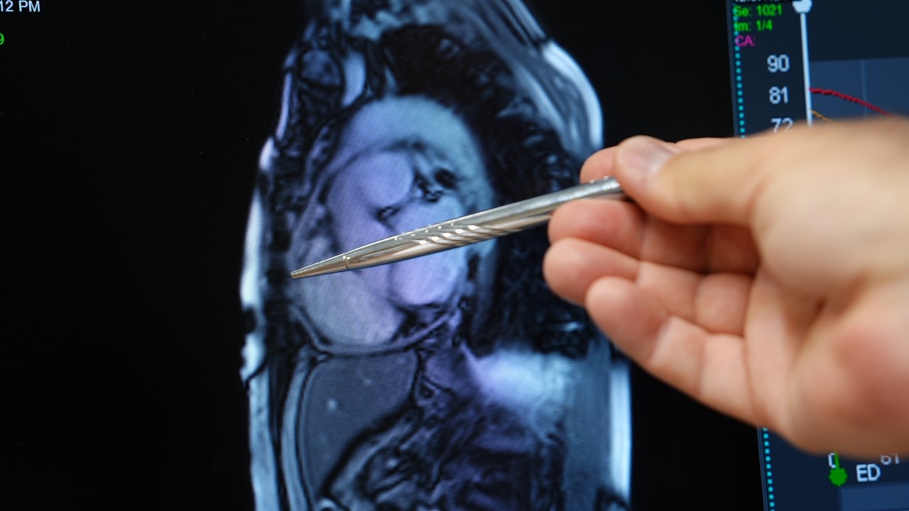 Kalbi taşlaştı, yıllarca yanlış tedavi gördü