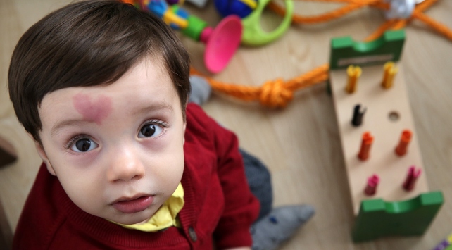 Kalp şeklinde doğum lekesiyle dünyaya geldi