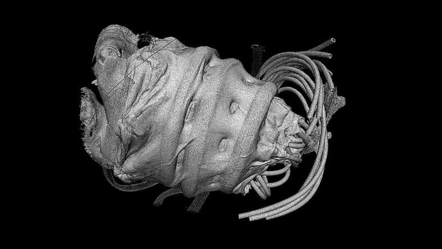 Kalp yetmezliği çeken hastalara müjde!