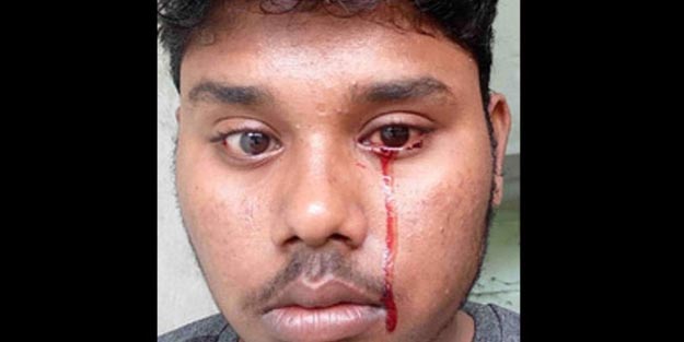 'Kan ağlıyor' deyimi gerçek oldu! Tıp dünyası şaşkın