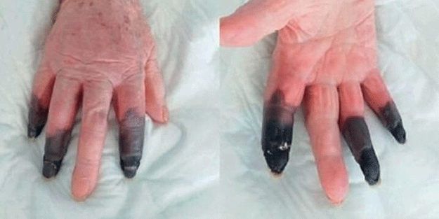 Kan dondurdu! Koroanavirüs parmaklarını bu hale getirdi