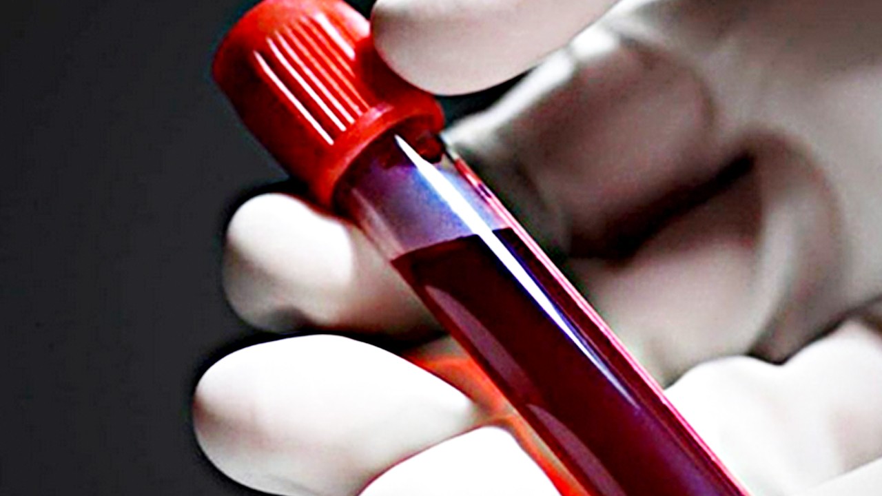 Kan grubunun erken felç riskinde etkili: Bilim adamları araştırma sonrası çarpıcı sonuçlar ortaya koydu