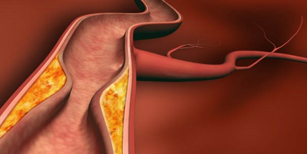 Kan pıhtılaşması sorununa dikkat! Kimler risk altında?