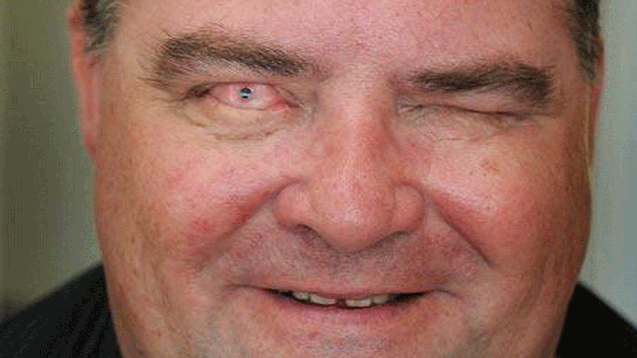 Kanada’da tıp tarihinde ilk! “Göz içinde diş” ameliyatıyla görme geri geldi