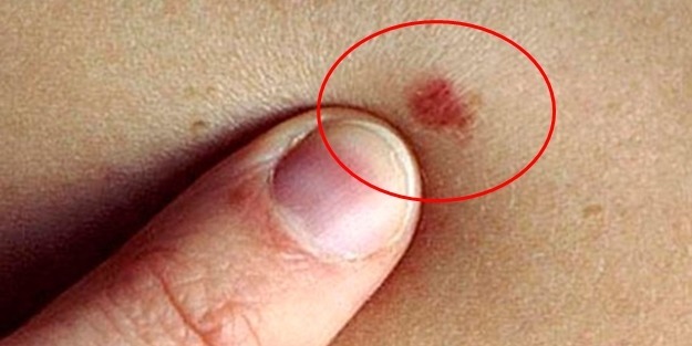 İşte kanserin belirtileri...