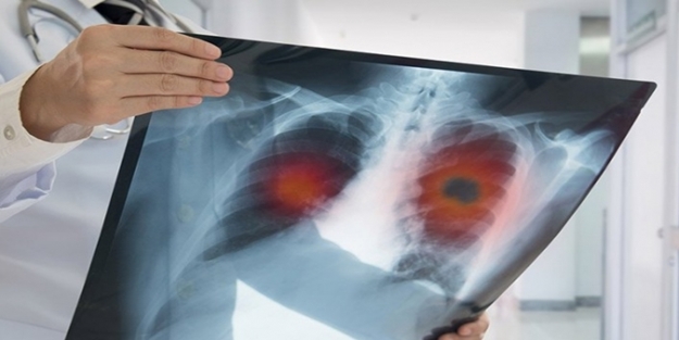 Kanserde erken tanı için tarama testi yaptırmayı unutmayın!