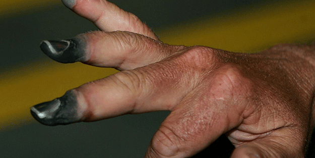 Kara aldanıp soğuk yanığı olmayın Bu belirtilere dikkat!