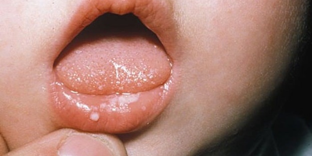 Karadut pekmezi bebeklerde pamukçuk problemini çözüyor