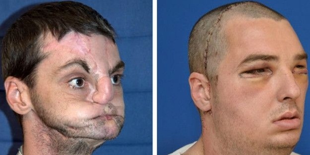 Kardeşinin yüzünün nakledildiği adamla tanıştı