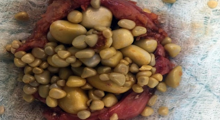 Karın ağrısı şikayetiyle gitti, safra kesesinden bunlar çıktı