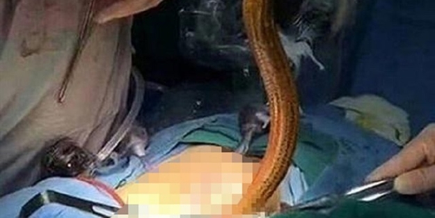 Karın ağrısıyla gitti yılan balığı çıktı