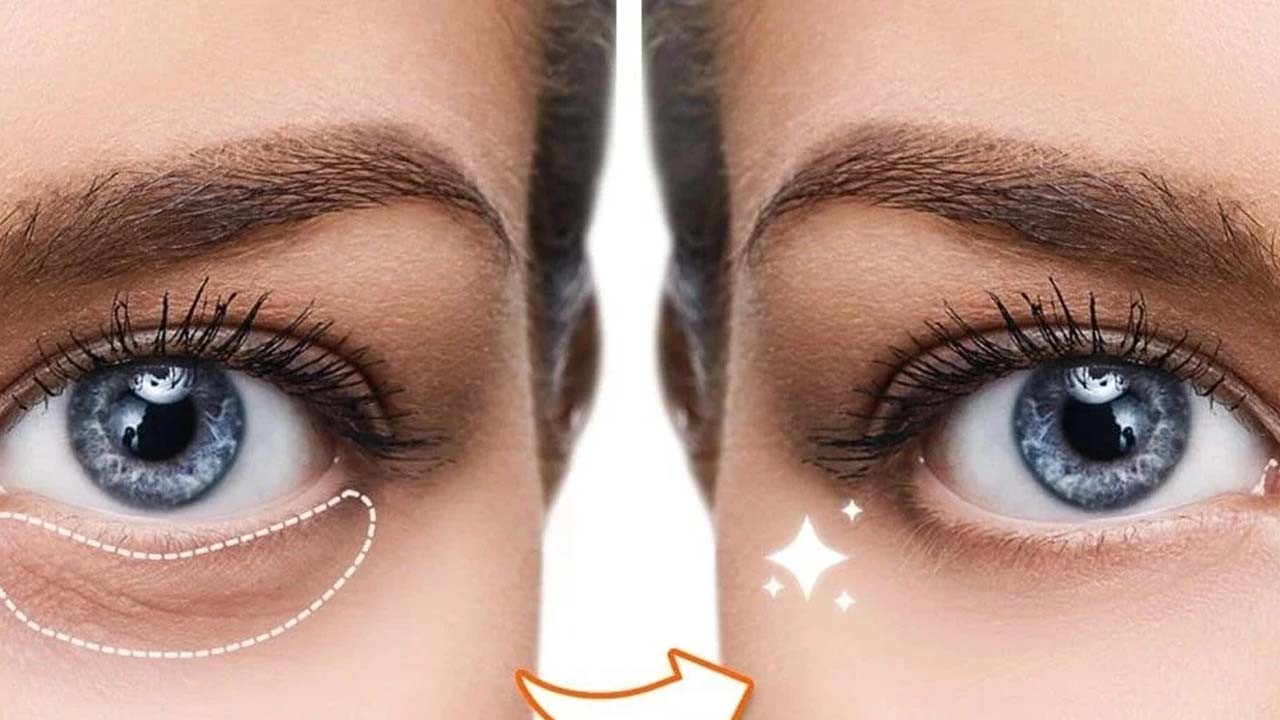 Karıştırıp göz altına sürün! Damarları daraltarak önüne geçiyor, morluklar bitiyor