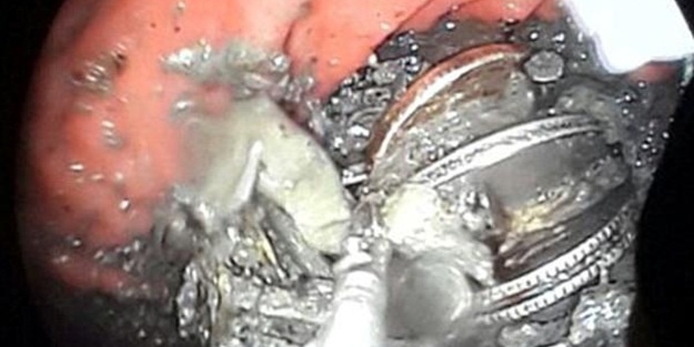 Karnı ağrıyordu, meğerse...