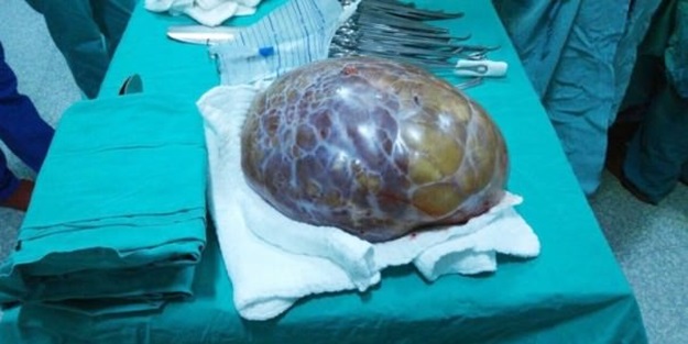 Karnından 6 kiloluk kitle çıkarıldı