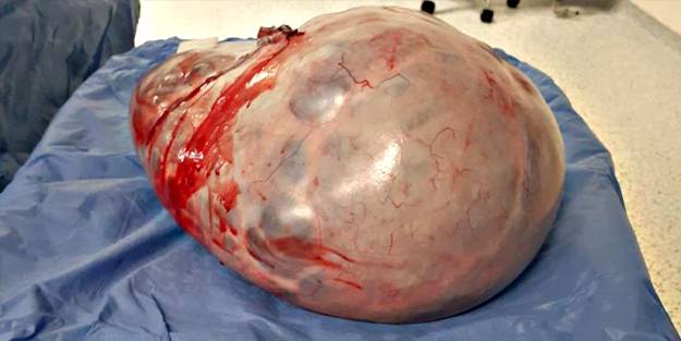 Karnından 9 kilo tümör çıktı