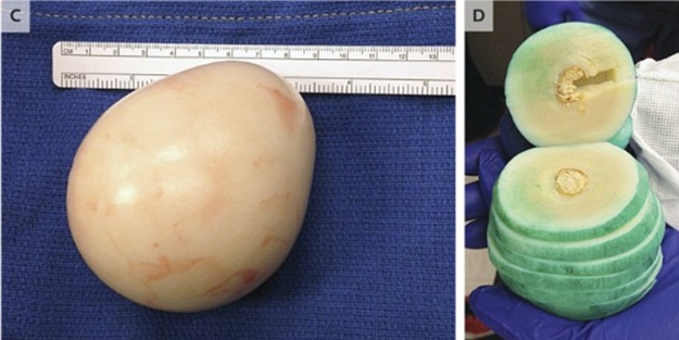 Karnından haşlanmış yumurta çıktı!