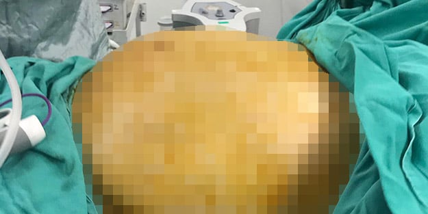 Karnından kilolarca ağırlıkta kitle çıkarıldı! 