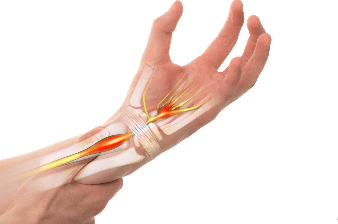 Karpal Tünel Sendromu belirtileri nelerdir? Ellerdeki uyuşma ve his kaybı karpal tünel midir?