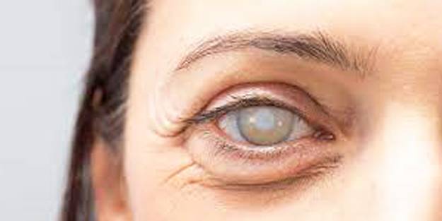 Katarakt hastalığında cerrahi tedavi