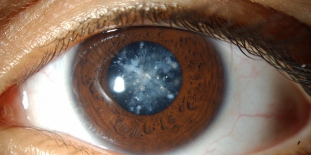 Katarakt bebeklerde de görülebiliyor!