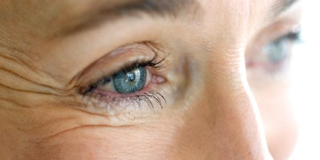 Kaz ayağı kırışıklıklarının tedavisi nasıldır?