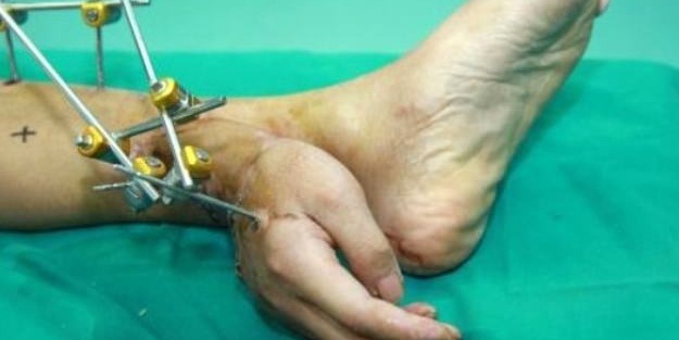 Kazada kopan elini ayağına diktiler!