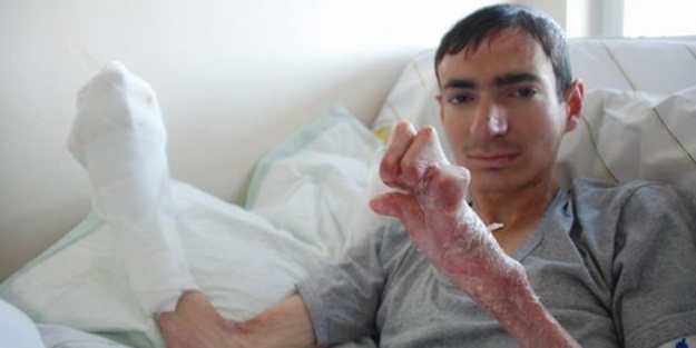 Kelebek hastası Mehmet ameliyat oldu!