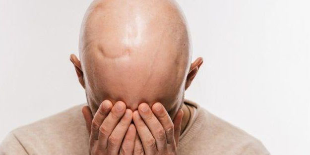 Kelliğin çaresi onda kabuklarını atmayın