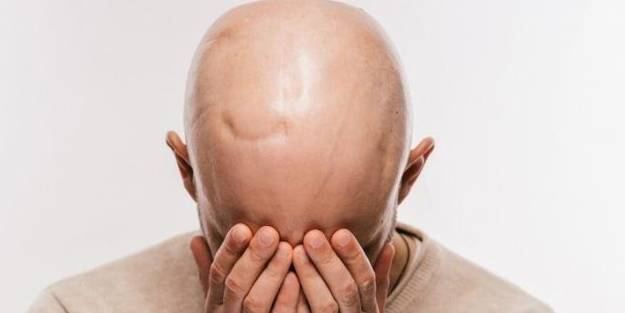 Kellik tedavisi için ilaç sarımsak kürü