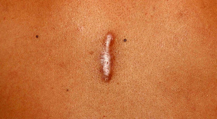 Keloid hastalığı nedir?
