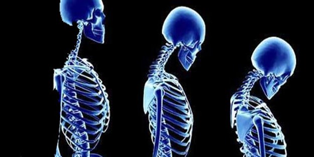 Kemik erimesi hanımların büyük derdi