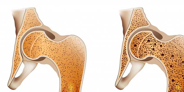 Kemik erimesini önlemek için bu besinleri tüketin