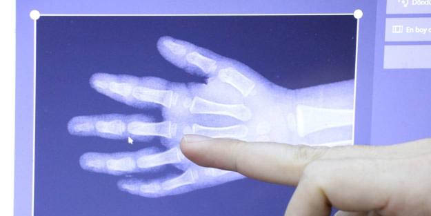 Kemik yaşını yapay zeka ile tespit edecek sistem geliştirildi